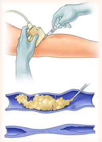 Tratamiento de varices en puerto vallarta