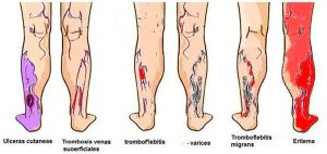 Varicose veins Complications