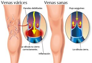 tratamiento de varices en puerto vallarta