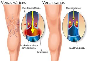 Treatment of varicose veins in Puerto Vallarta